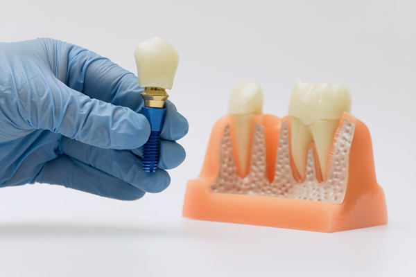 How To Know You Are A Candidate For Dental Implants