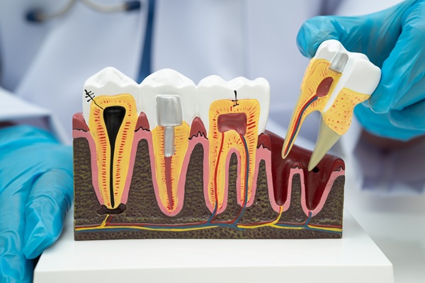 Common Myths About Root Canals, Debunked By Dentists